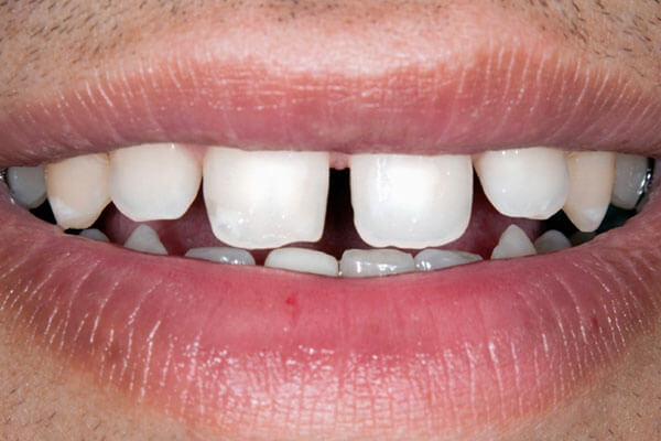 Dental Gaps