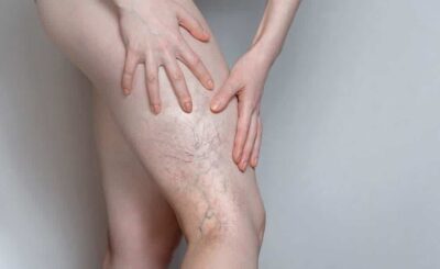 Spider Veins