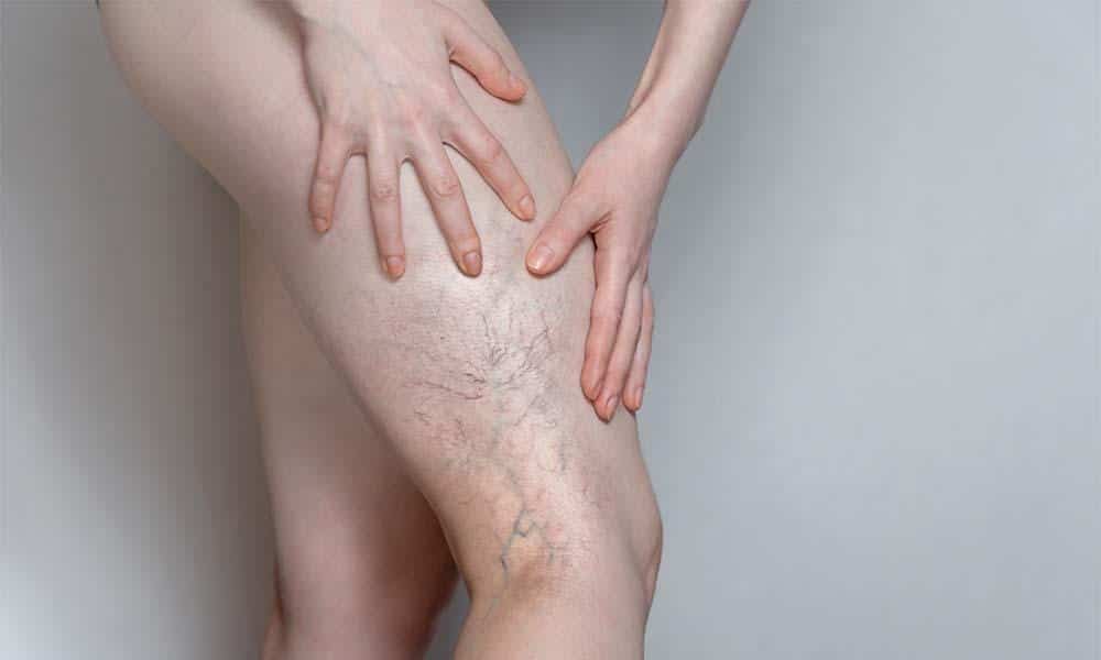 Spider Veins