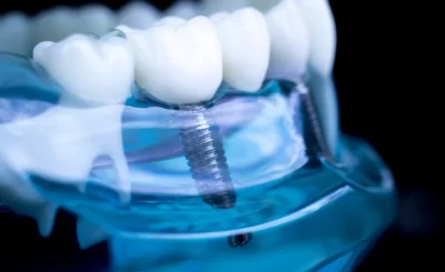 Dental Implant