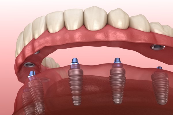 Dental Implant