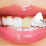 Exploring The Potential Merits of Invisalign For Overall Wellness