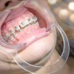 Best Addiction Recovery Support: How to Choose the Right Center